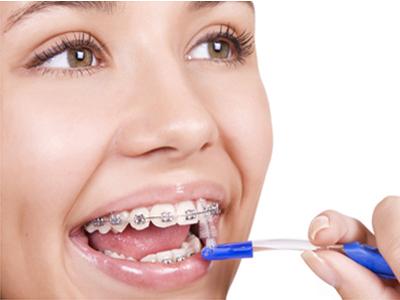 Cara Atasi Sariawan Akibat Penggunaan Kawat Gigi