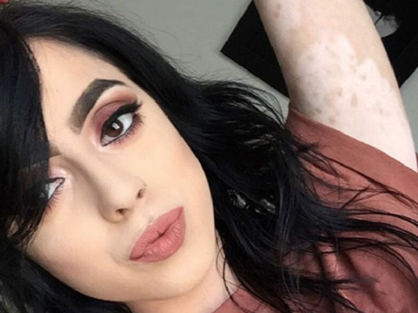 Keren, Wanita Penderita Vitiligo Ini 'Sulap' Tubuhnya Bak Sebuah Peta!