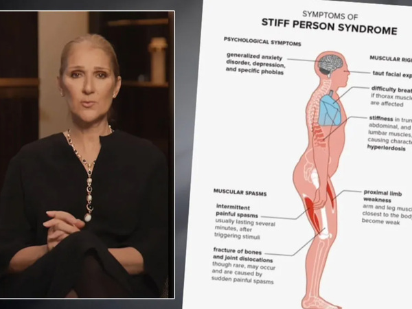 Seberapa Bahaya Penyakit Langka Stiff-Person Syndrome?