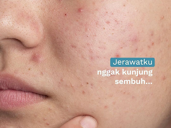 5 Step Skincare untuk Lebih Cepat Mengatasi Jerawat