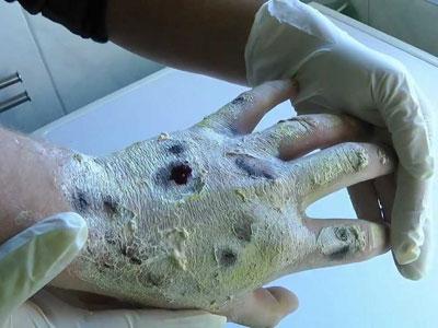 Krokodil, Narkoba Terganas dari Rusia Ciptakan Zombie