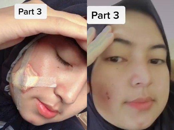 Viral Wanita Pakai Masker Kain Berujung Dioperasi, Kenapa?