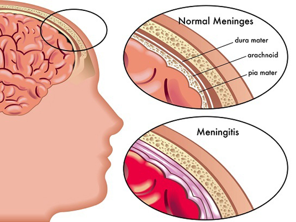 Kenali dan Cari Tahu Penyakit Meningitis, Penyakit yang Diderita Oleh Olga Syahputra