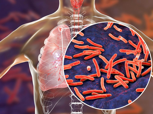 Alasan Pasien TBC Putus Obat Karena Pandemi Virus Corona