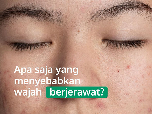 Jerawatan Jangan Panik! Begini Cara Kenali dan Mengatasinya Menurut Dokter Kulit